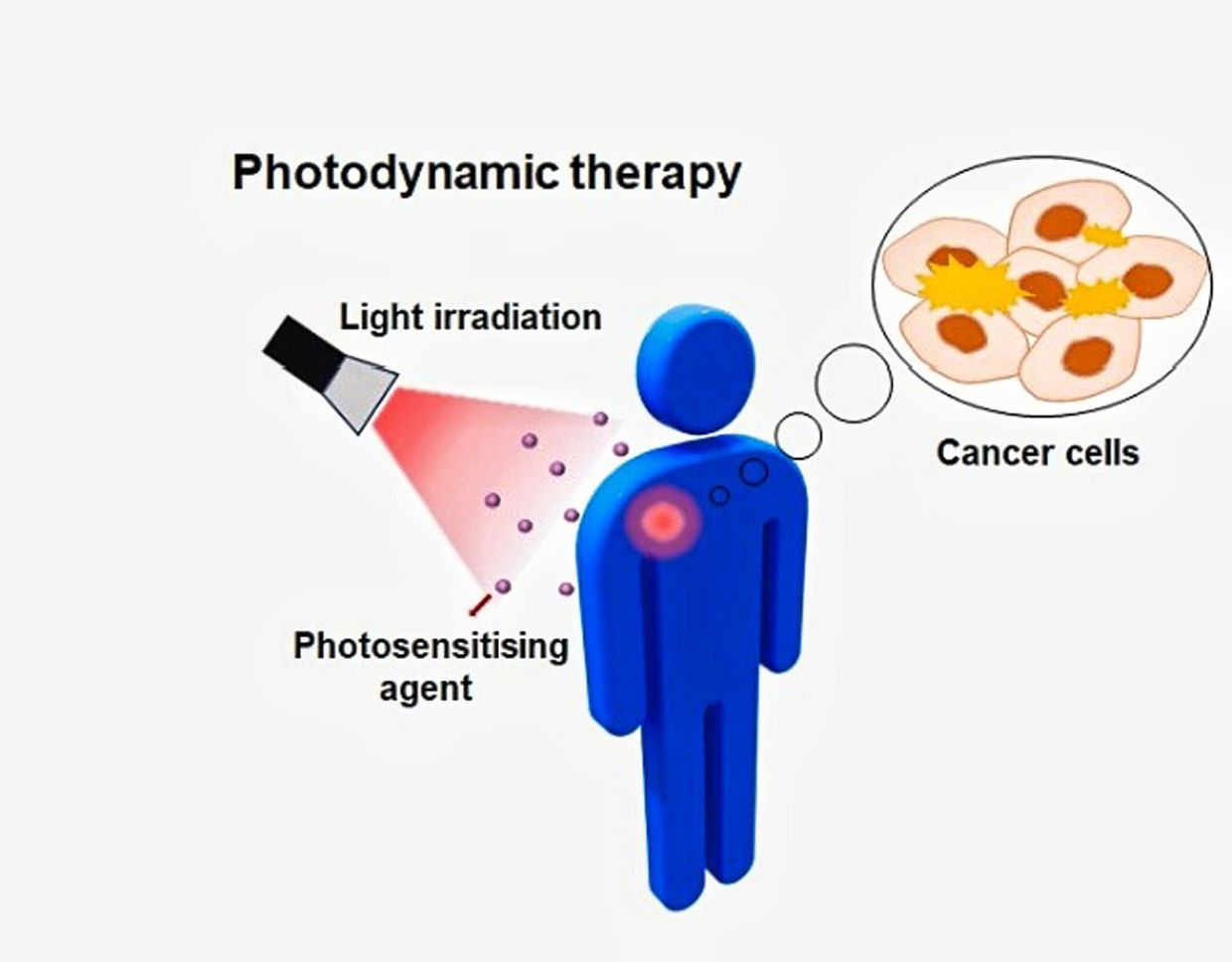PDT works best for cancer cells that can be reached by light such as skin cancer, which means it’s not suitable to treat all types of cancer.