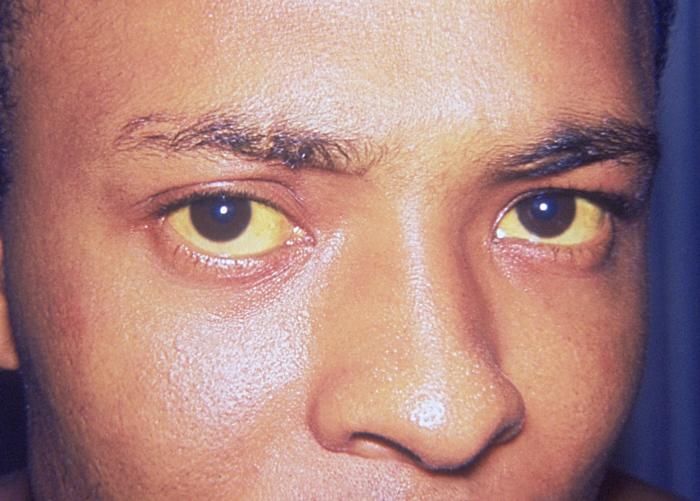 When itching is combined with yellowing of the eyes, it is likely a sign of hepatitis, cirrhosis or bile duct obstruction. — Wikimedia Commons
