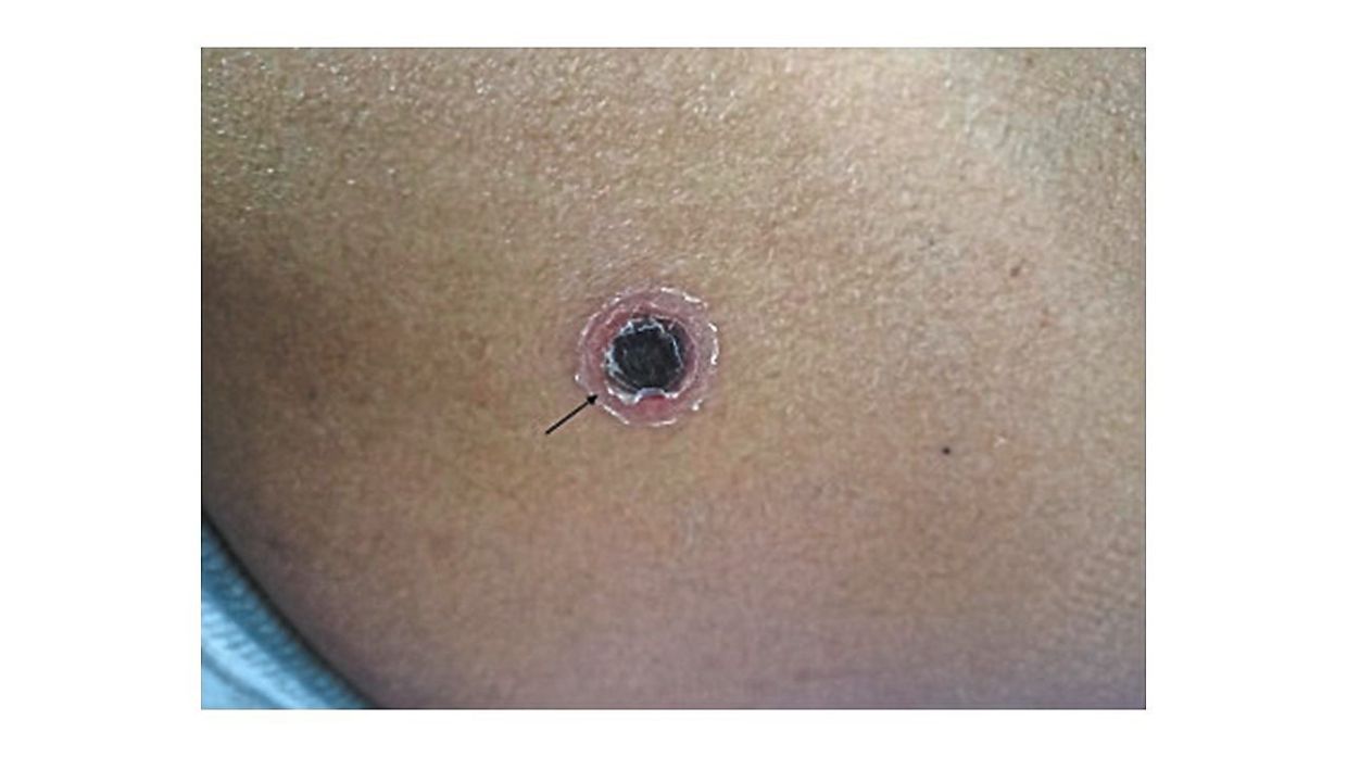 A typical eschar observed in a patient with scrub typhus. — The American Journal of Tropical Medicine and Hygiene