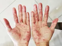 Over 11,800 HFMD cases recorded in Kelantan