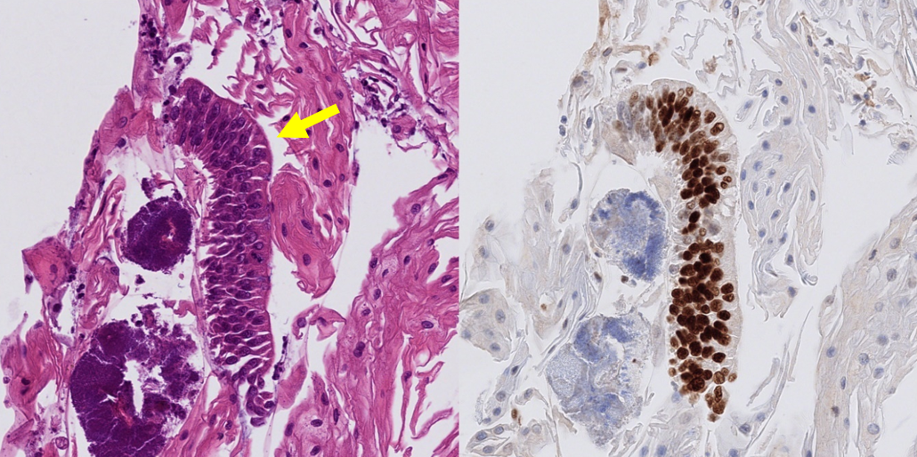 A capsule sponge specimen showing abnormal cells that resemble early oesophageal cancer (left, yellow arrow), and positive staining (brown colour) for a cancer-causing gene called p53 (right). — Dr GRETA MARKERT
