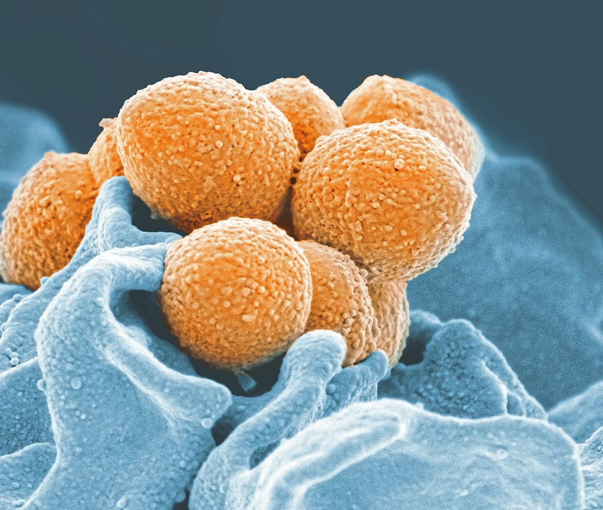 Group A Streptococcus bacteria (orange), seen here in a colourised scanning electron microscope image, are the only common cause of sore throats that warrant the use of antibiotics. — NIAID