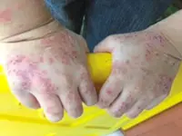 How Covid-19 triggered more skin allergies