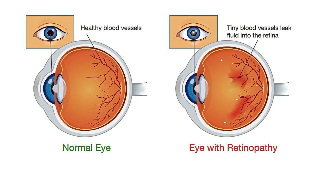 Constant high blood sugar levels can result in the growth of weak blood vessels in the eye, which cause the multiple eye problems associated with diabetes. — Handout