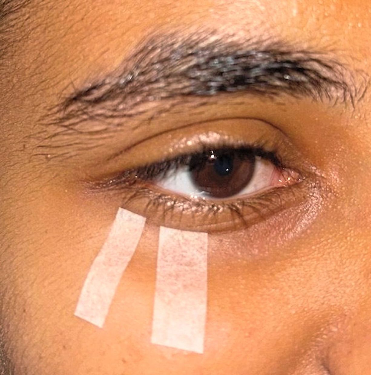 With entropion cases, the temporary solution is to tape the lower eyelid to prevent the eyelash from touching the cornea.