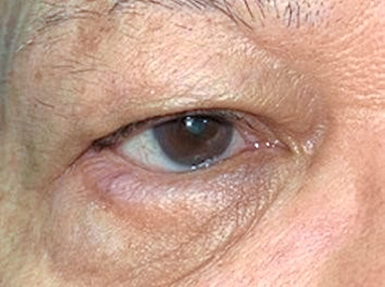 Here's a case of entropion, or the lower lid turning inwards.