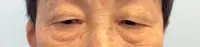 These are not sleepy eyes, but a weakness of the eyelids