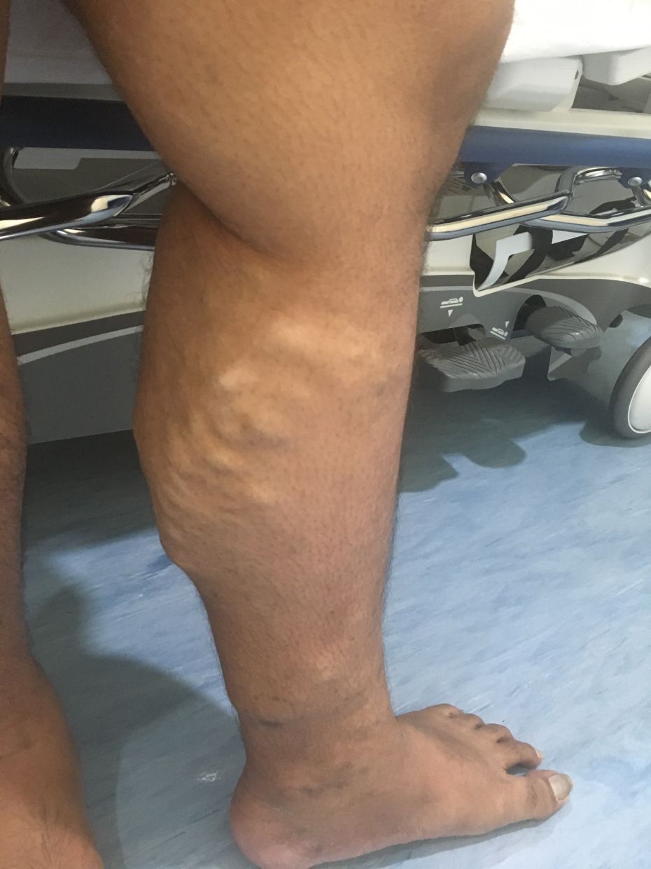 Varicose veins are one of the common early warning signs of CVI. — Dr TAN KIA LEAN