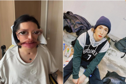Injured dancer Lee Kai Yin shares first photo of face since Mirror accident in 2022