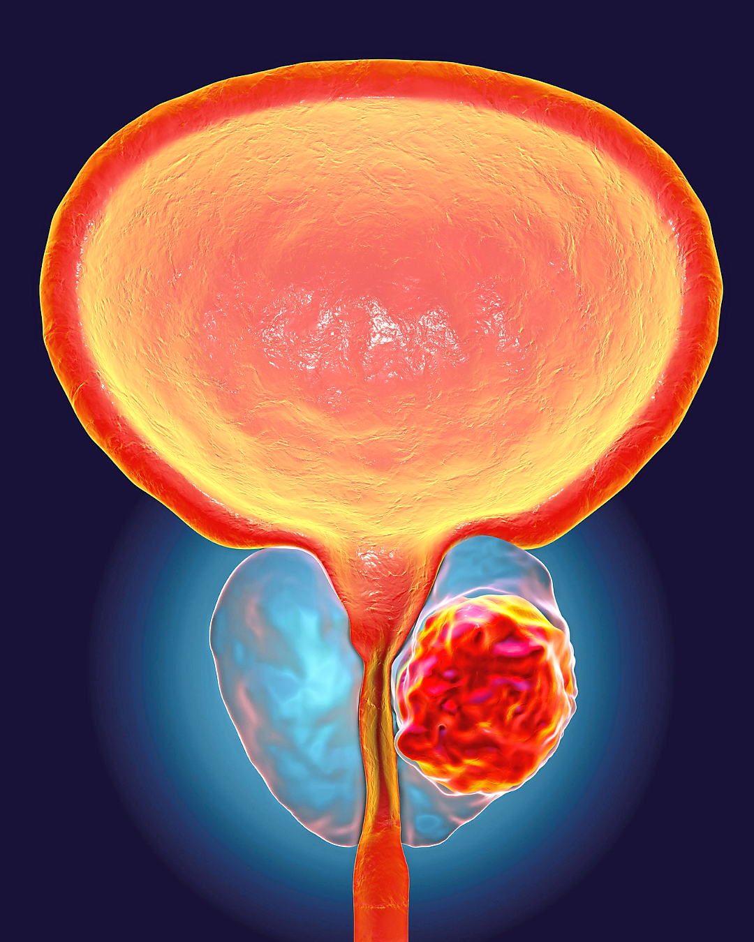 Treatment for prostate cancer depends on what stage the tumour is at. — Photos: Canva