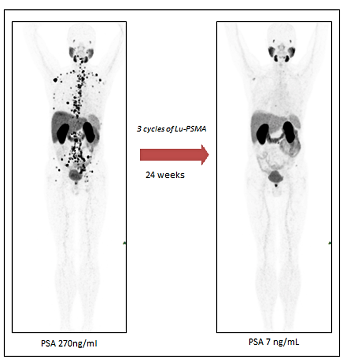 The 3D Ga68-PET images show the sites of the metastatic prostate cancer before and after treatment. There is significant reduction in the number of lesions and the PSA levels after three cycles of Lu-PSMA therapy. — Dr ALEX KHOO CHEEN HOE