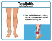 Pain at the back of your foot? Do this exercise