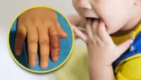 China mum wraps baby’s finger to stop ‘unhygienic’ sucking, leads to tissue damage