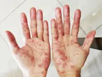 Philippines tallies 37,368 hand, foot, mouth disease cases since January