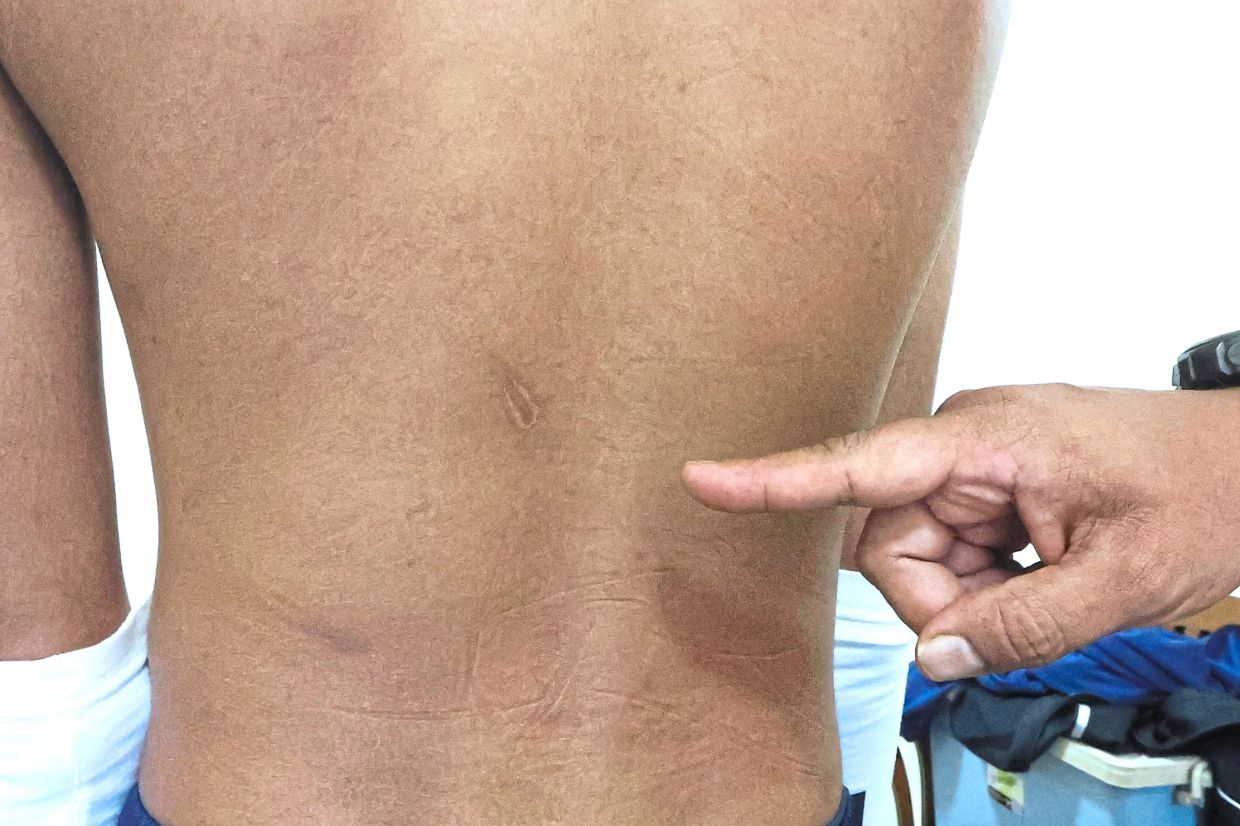 Back injuries sustained by Gan from the physical abuse he suffered for almost 10 months during his ordeal in Myanmar and Thailand after being scammed by call centre syndicates in both countries.