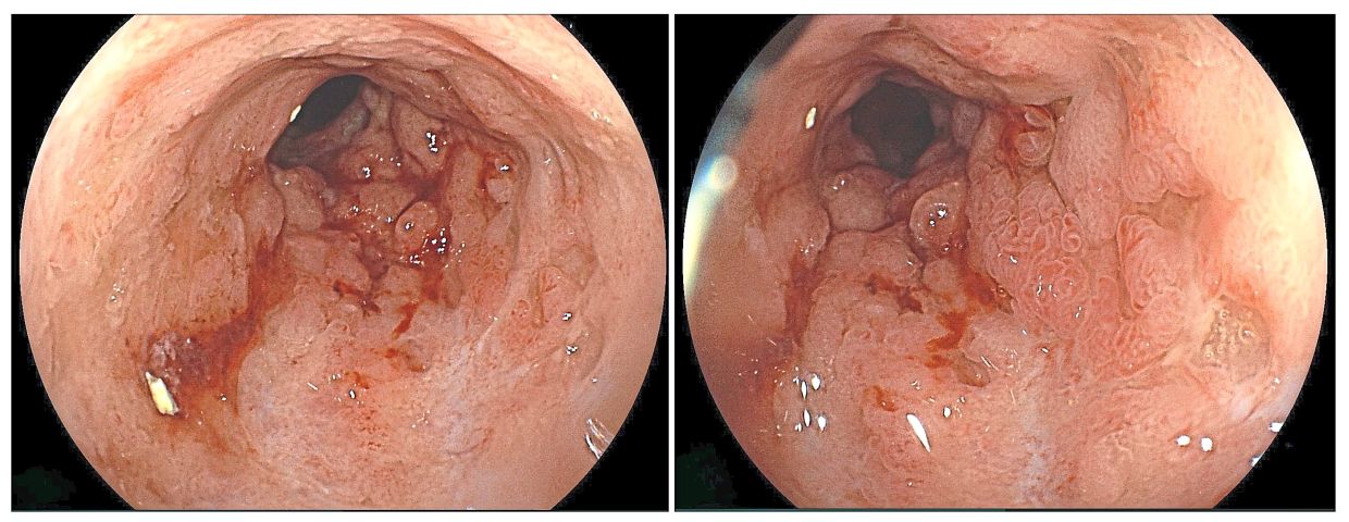 Endoscopic view of Hairi’s colon prior to biologic therapy, which shows evidence of multiple ulcers, friable colon innermost lining and mild bleeding. — Photos: Dr KHAIRUL NAJMI MUHAMMAD NAWAWI