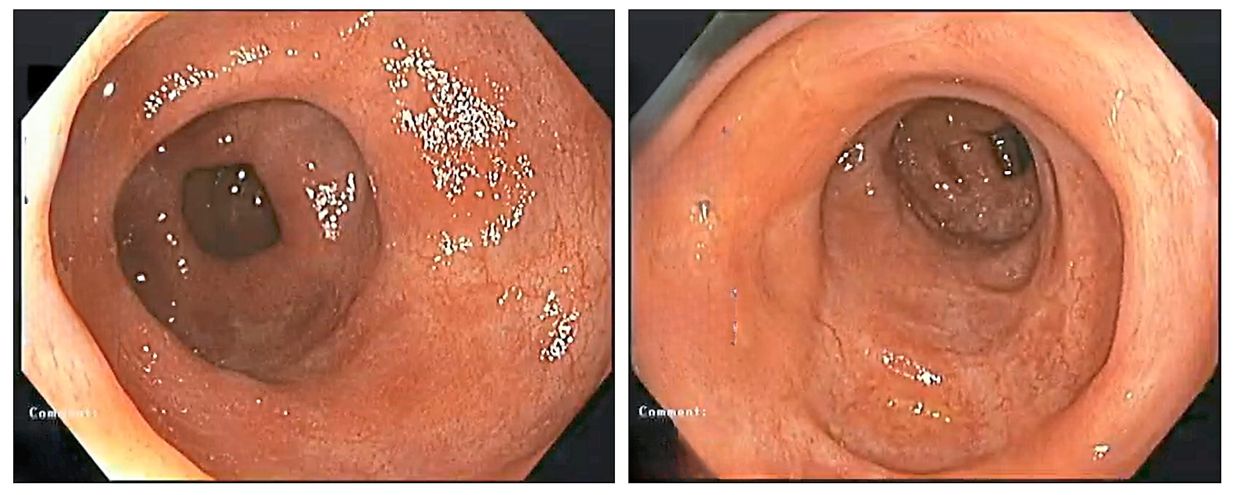 Hairi’s colon 24 months after initiation of biologic therapy; note the healing of the colon lining with disappearance of the ulcers.