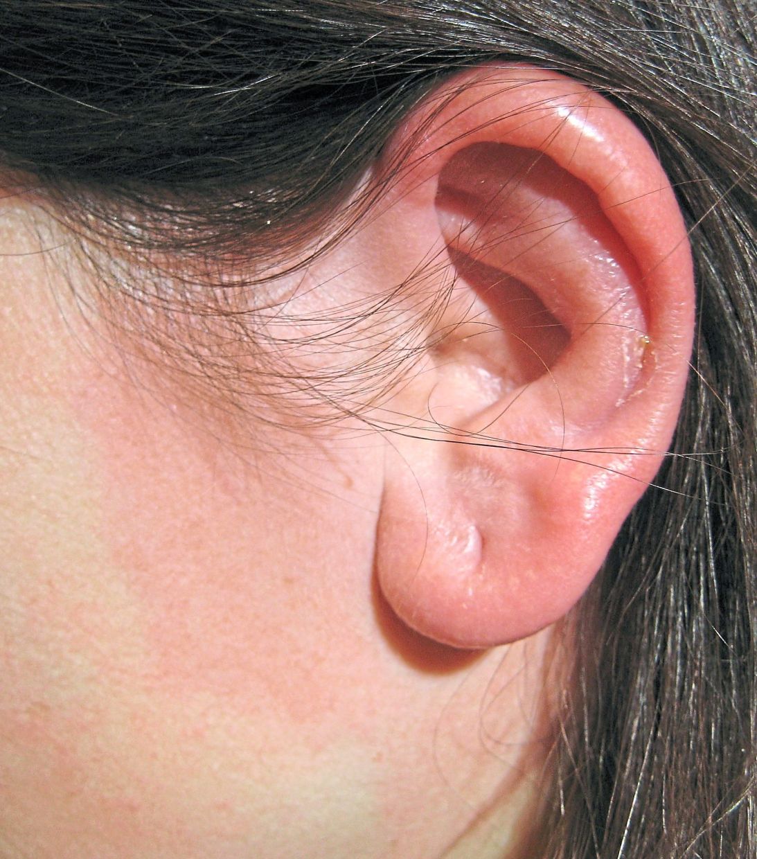 The rash of erysipelas can always be clearly distinguished from normal skin, as seen in this case involving the patient’s ear. — Wikimedia Commons