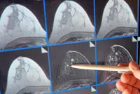 Dense breasts and tumours look the same on a mammogram