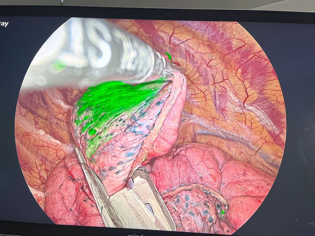 The ICG dye emits a flourescent green colour under near-infrared light. This guides the surgeon to precisely target the area of interest where the nodule or suspected cancer is located.
