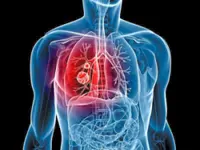 Guidelines for treating early stage lung cancer