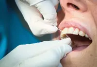 Do I need professional teeth cleaning?