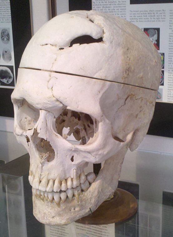 Gage’s skull is currently on display at the Warren Anatomical Museum at Harvard Medical School in the United States. The exit wound made by the metal rod can be clearly seen at the top of the skull.
