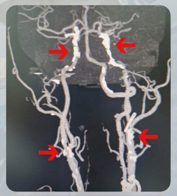 The arrows point to Eddy’s badly-diseased brain and carotid arteries before the operation. — Photos: Sri Kota Specialist Medical Centre