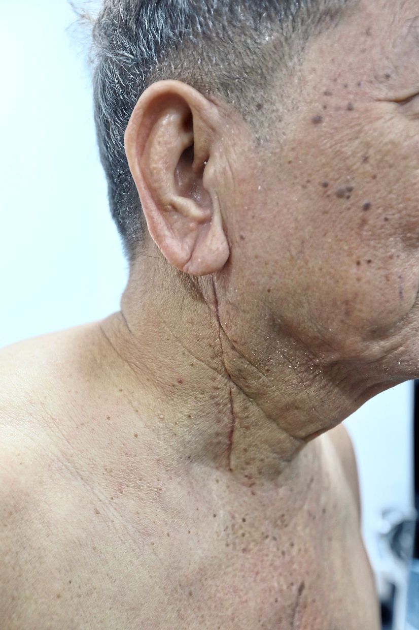 Eddy’s scar has healed beautifully and the businessman has now resumed his regular routine in Yogyakarta. — LOW LAY PHON/The Star