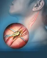 Stroke prevention: Cleaning out the plaque in your carotid artery