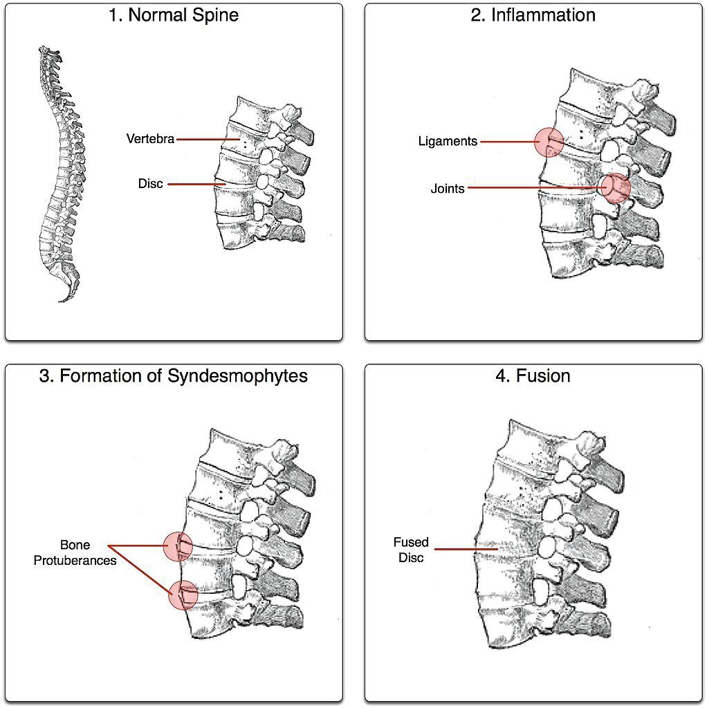 The disease process that occurs in ankylosing spondylitis. — Photos: Wikimedia Commons