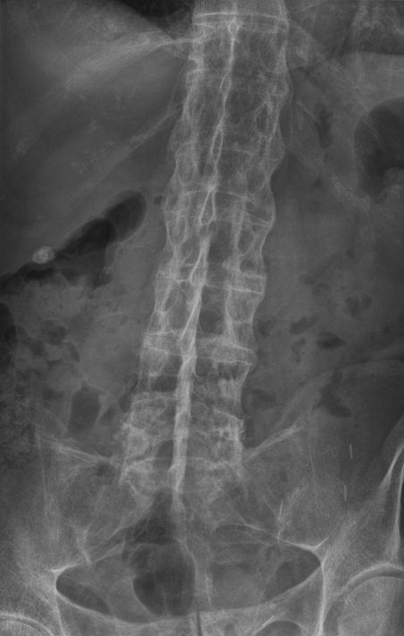 An X-ray image of a bamboo spine in a patient with ankylosing spondylitis.