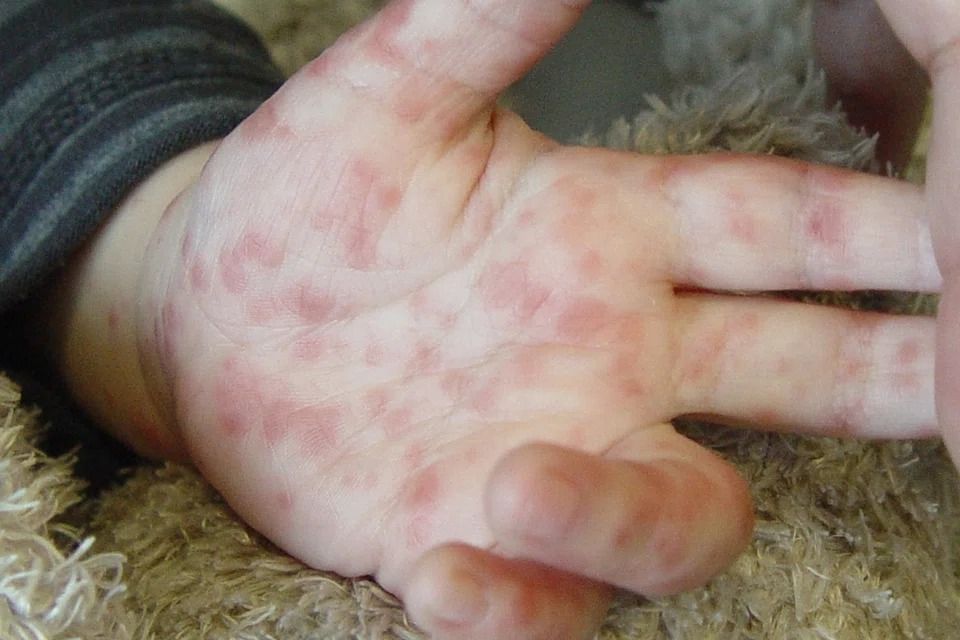 Hand, foot and mouth disease cases on the rise in Vietnam’s Ho Chi Minh City