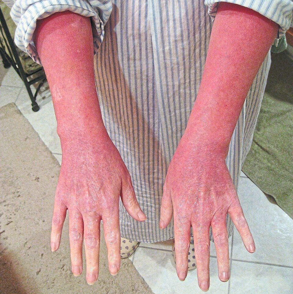 When stopping steroid creams makes your skin worse