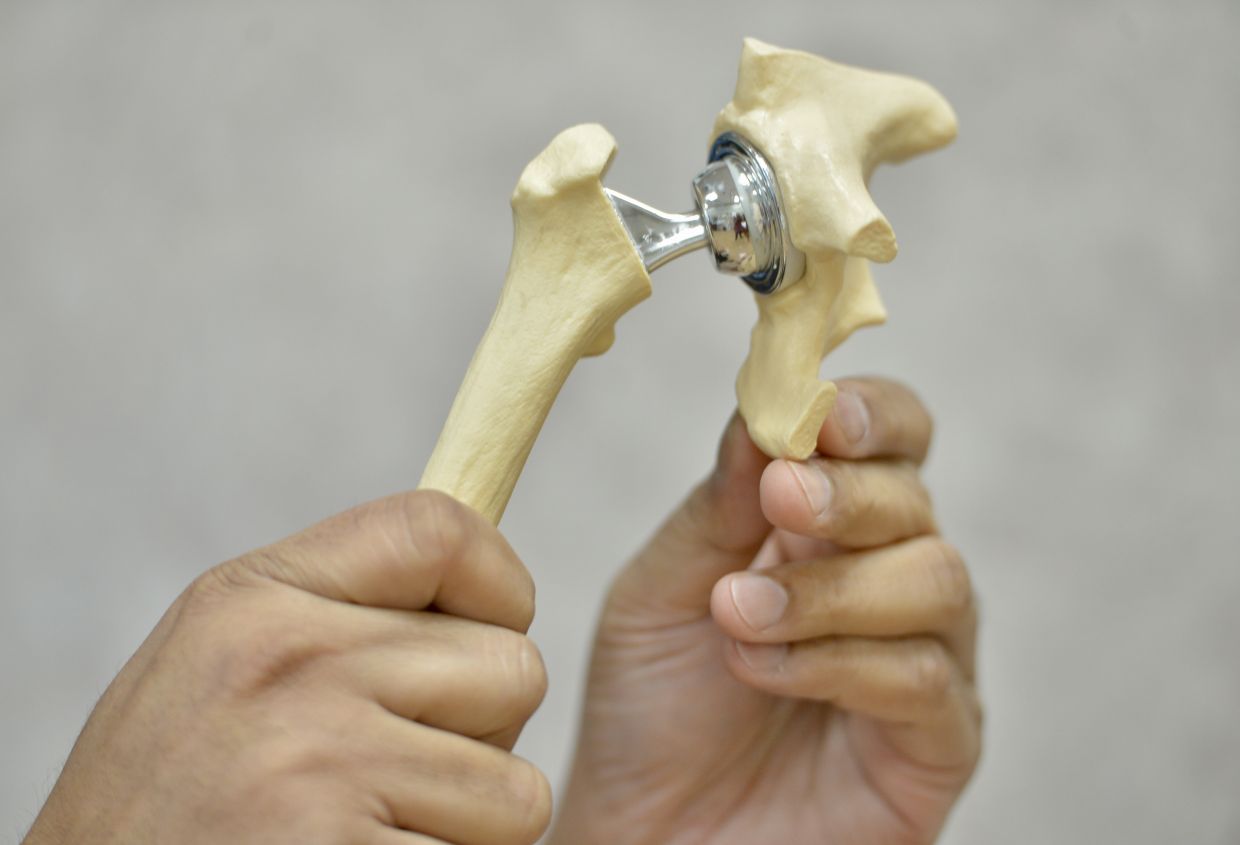 To fix the hip fracture, an artificial part is sometimes used to replace the joint via a hip replacement surgery.