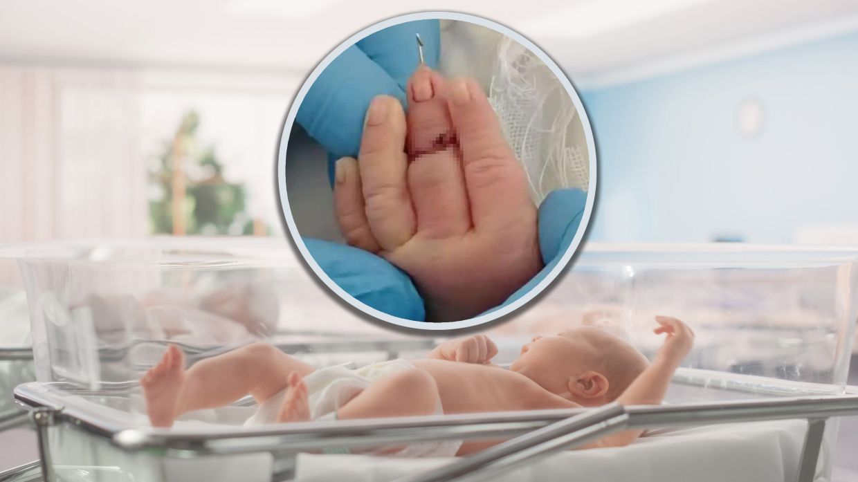 China midwife accidentally severs baby’s middle finger, results in reattachment surgery