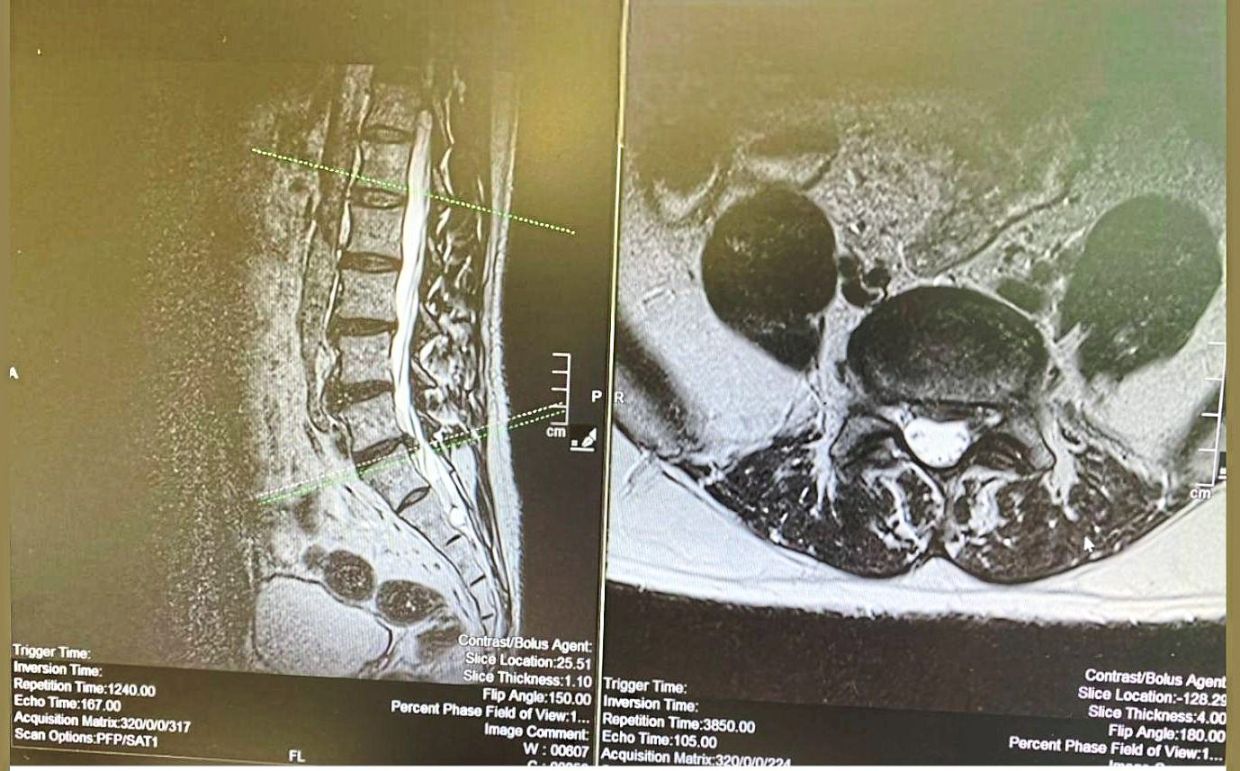 Slipped discs – seen here at L5–S1 level (delineated by the dotted green lines) – are one of the most common spinal conditions neurosurgeons treat. — Prince Court Medical Centre