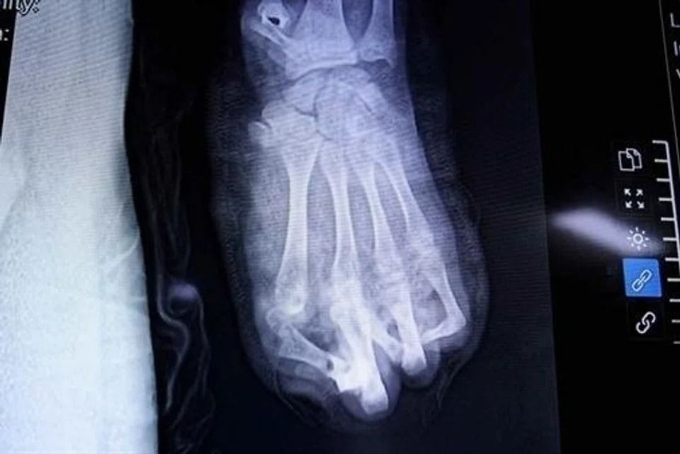 Teenager in Vietnam loses most of left hand in improvised firework explosion