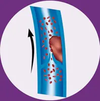 Antiphospholipid syndrome: When your blood ‘sticks’ together