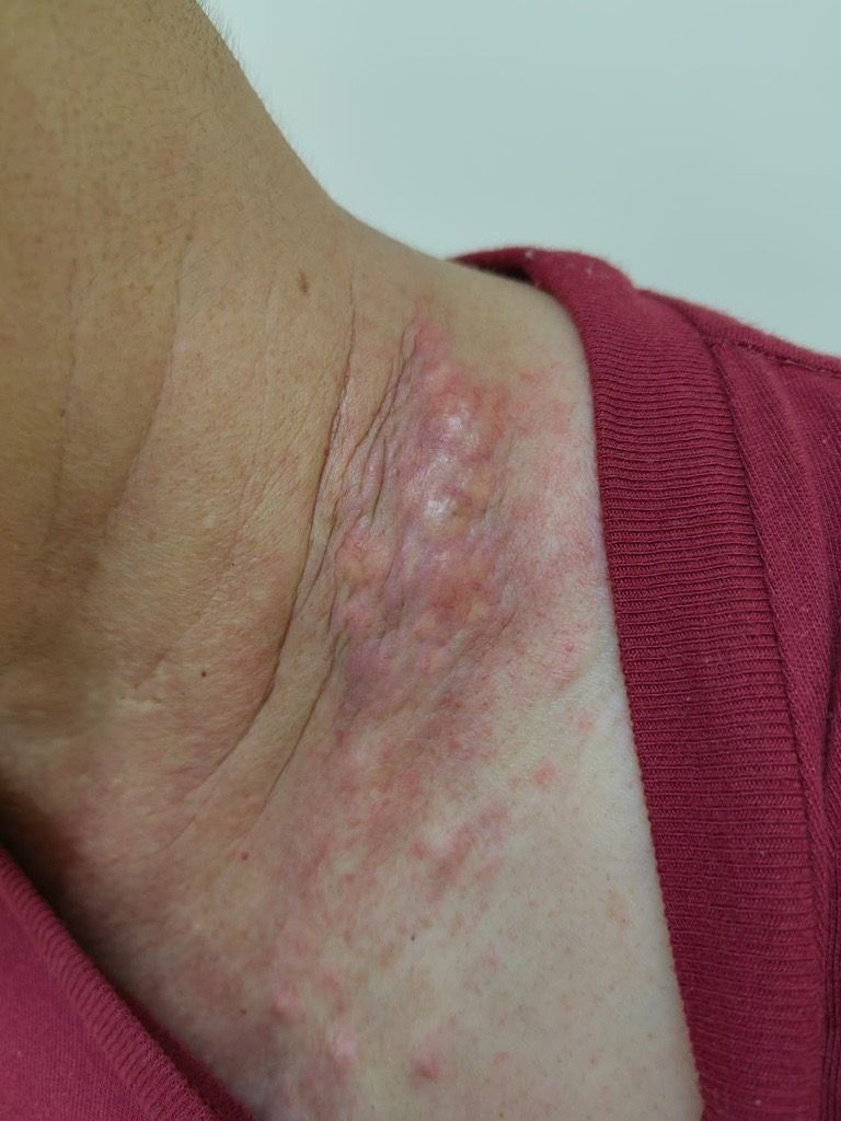 What HS looks like on a patient.