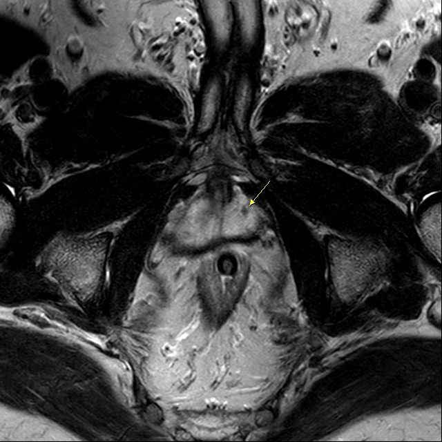 The arrow shows a small dark area in the prostate that is the cancer. Using Hifu, the doctor can precisely target and destroy this area together with a 10mm safety margin around it.