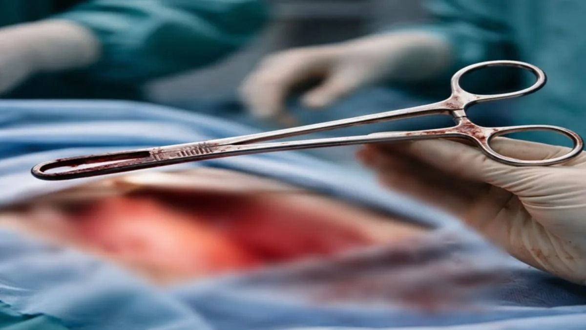 Five years on, surgical instrument removed from Kerala woman’s abdomen