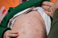 Babies travelling to countries with high measles incidence need to get MMR vaccine early: Singapore Health Ministry