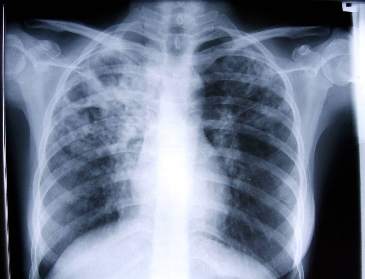 Human Writes: Keeping track of TB in our midst - The Star Malaysia by Mangai Balasegaram