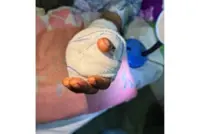 Toe successfully transplanted to replace severed thumb at Yangon Orthopaedic Hospital