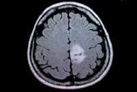 New, highly-accurate blood test for brain tumours