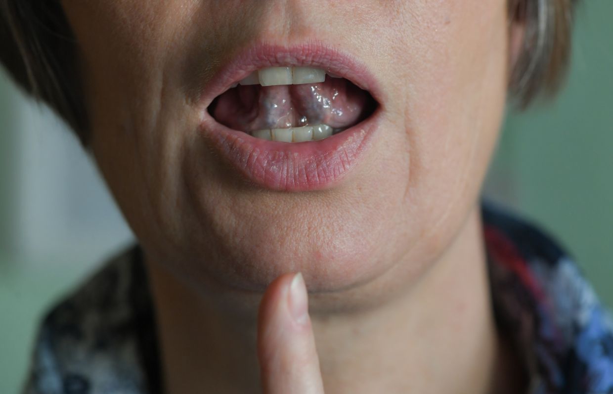 Scientists use saliva for non-invasive, AI-based Parkinson's test