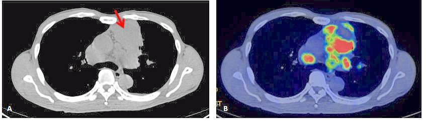 Nuclear medicine enables the entire tumour to be mapped, while a biopsy only samples part of the tumour. In this example, the left CT image (A) shows where the left lung mass was biopsied (red arrow) and came back negative for cancer. This was because only dead tissue (blue) was at the site of the biopsy as can be seen in the 18F-FDG PET-CT scan (B). The cancer tissues (red with a yellow-green border) are present in other parts of the mass. — Dr ALEX KHOO CHEAN HOE