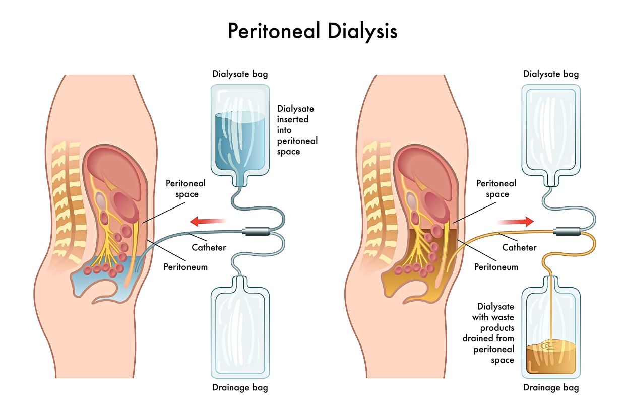 Peritoneal dialysis utilises the patient’s peritoneal membrane to help filter out waste from the blood.