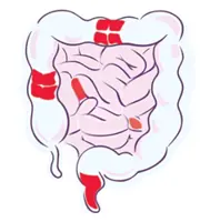 The trigger behind gut scarring in Crohn’s disease